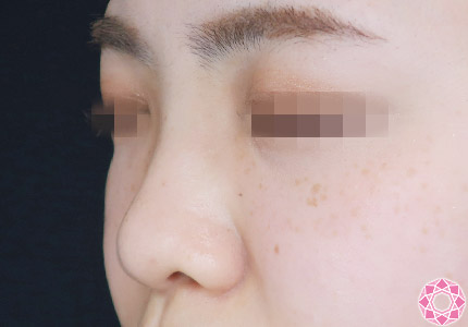 年代：20代 施術名：プチ隆鼻術（ヒアルロン酸） 施術前｜【公式】東京形成美容外科