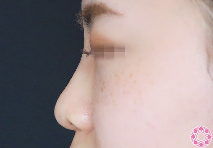 年代：20代 施術名：プチ隆鼻術（ヒアルロン酸） 施術前｜【公式】東京形成美容外科