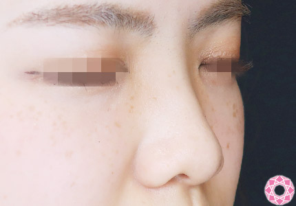 年代：20代 施術名：プチ隆鼻術（ヒアルロン酸） 施術前｜【公式】東京形成美容外科