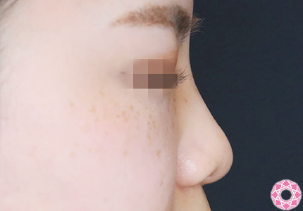 年代：20代 施術名：プチ隆鼻術（ヒアルロン酸） 施術前｜【公式】東京形成美容外科