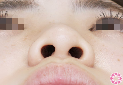 年代：20代 施術名：プチ隆鼻術（ヒアルロン酸） 施術前｜【公式】東京形成美容外科