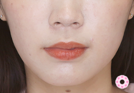 年代：20代 施術名：エラ取り（ボトックス） 施術後｜【公式】東京形成美容外科