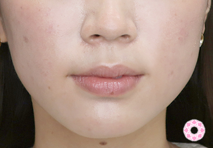 年代：20代 施術名：エラ取り（ボトックス） 施術前｜【公式】東京形成美容外科