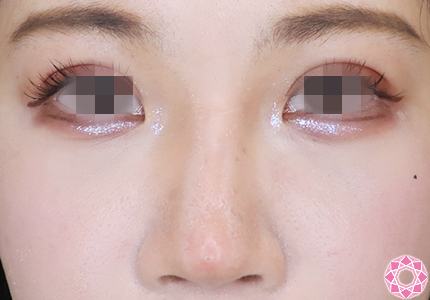 年代：20代 施術名：プチ隆鼻術（ヒアルロン酸） 施術後｜【公式】東京形成美容外科