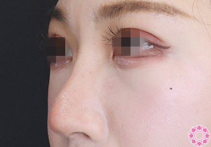 年代：20代 施術名：プチ隆鼻術（ヒアルロン酸） 施術後｜【公式】東京形成美容外科