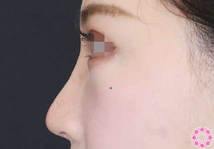 年代：20代 施術名：プチ隆鼻術（ヒアルロン酸） 施術後｜【公式】東京形成美容外科