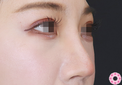 年代：20代 施術名：プチ隆鼻術（ヒアルロン酸） 施術後｜【公式】東京形成美容外科