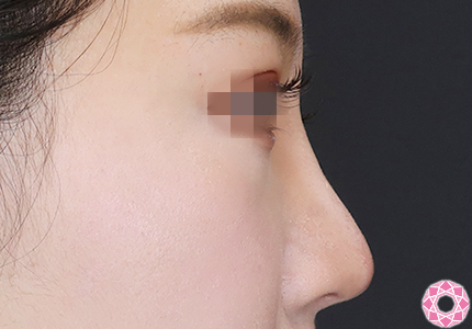 年代：20代 施術名：プチ隆鼻術（ヒアルロン酸） 施術後｜【公式】東京形成美容外科