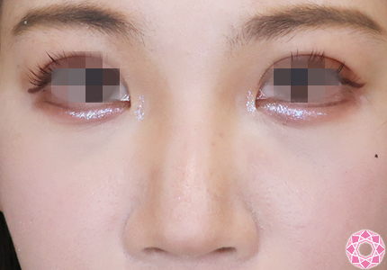 年代：20代 施術名：プチ隆鼻術（ヒアルロン酸） 施術前｜【公式】東京形成美容外科