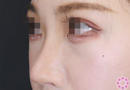 年代：20代 施術名：プチ隆鼻術（ヒアルロン酸） 施術前｜【公式】東京形成美容外科