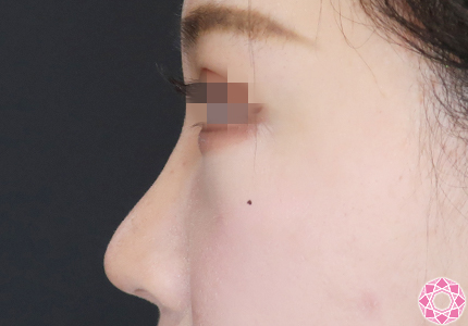 年代：20代 施術名：プチ隆鼻術（ヒアルロン酸） 施術前｜【公式】東京形成美容外科