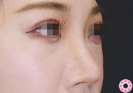 年代：20代 施術名：プチ隆鼻術（ヒアルロン酸） 施術前｜【公式】東京形成美容外科