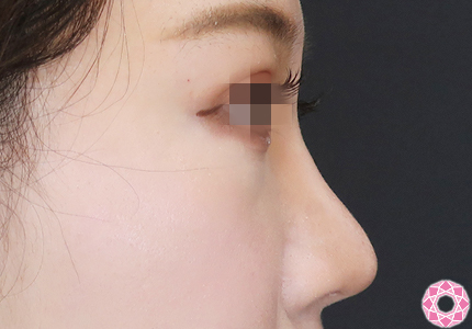 年代：20代 施術名：プチ隆鼻術（ヒアルロン酸） 施術前｜【公式】東京形成美容外科