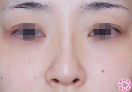 年代：30代 施術名：プチ隆鼻術（ヒアルロン酸） 施術後｜【公式】東京形成美容外科