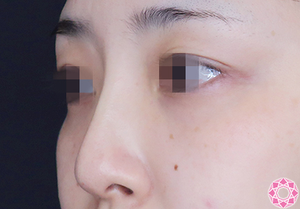 年代：30代 施術名：プチ隆鼻術（ヒアルロン酸） 施術後｜【公式】東京形成美容外科