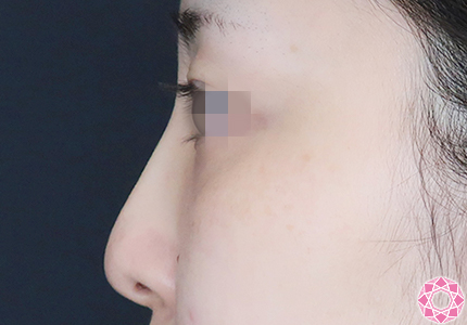 年代：30代 施術名：プチ隆鼻術（ヒアルロン酸） 施術後｜【公式】東京形成美容外科