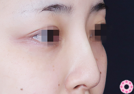 年代：30代 施術名：プチ隆鼻術（ヒアルロン酸） 施術後｜【公式】東京形成美容外科