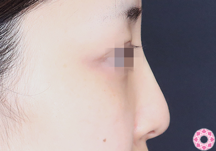 年代：30代 施術名：プチ隆鼻術（ヒアルロン酸） 施術後｜【公式】東京形成美容外科