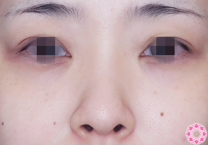 年代：30代 施術名：プチ隆鼻術（ヒアルロン酸） 施術前｜【公式】東京形成美容外科