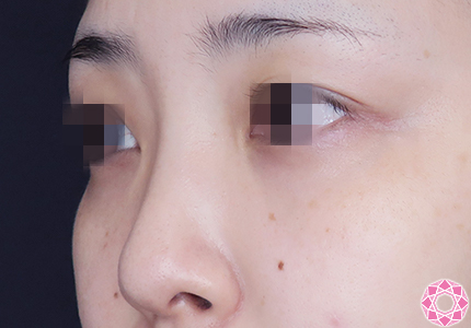 年代：30代 施術名：プチ隆鼻術（ヒアルロン酸） 施術前｜【公式】東京形成美容外科