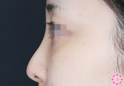 年代：30代 施術名：プチ隆鼻術（ヒアルロン酸） 施術前｜【公式】東京形成美容外科