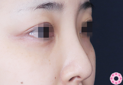 年代：30代 施術名：プチ隆鼻術（ヒアルロン酸） 施術前｜【公式】東京形成美容外科