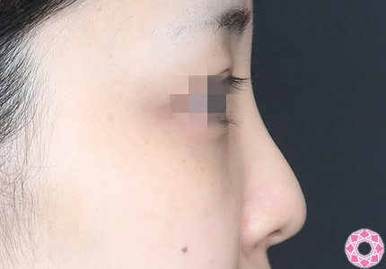 年代：30代 施術名：プチ隆鼻術（ヒアルロン酸） 施術前｜【公式】東京形成美容外科