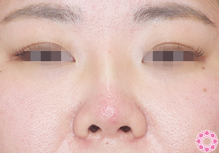 年代：30代 施術名：プチ隆鼻術（ヒアルロン酸） 施術後｜【公式】東京形成美容外科