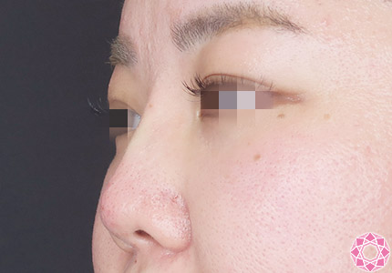 年代：30代 施術名：プチ隆鼻術（ヒアルロン酸） 施術後｜【公式】東京形成美容外科