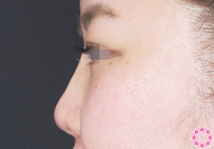 年代：30代 施術名：プチ隆鼻術（ヒアルロン酸） 施術後｜【公式】東京形成美容外科