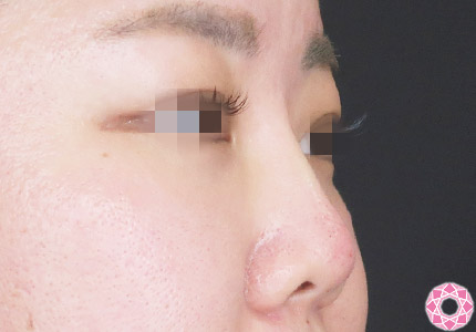 年代：30代 施術名：プチ隆鼻術（ヒアルロン酸） 施術後｜【公式】東京形成美容外科