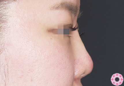 年代：30代 施術名：プチ隆鼻術（ヒアルロン酸） 施術後｜【公式】東京形成美容外科