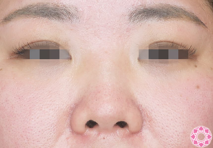 年代：30代 施術名：プチ隆鼻術（ヒアルロン酸） 施術前｜【公式】東京形成美容外科