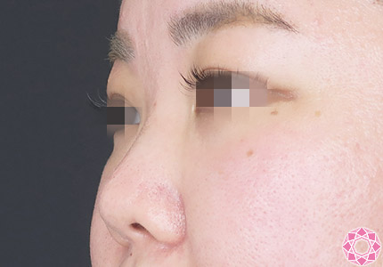 年代：30代 施術名：プチ隆鼻術（ヒアルロン酸） 施術前｜【公式】東京形成美容外科