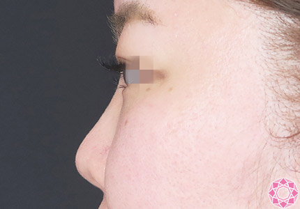 年代：30代 施術名：プチ隆鼻術（ヒアルロン酸） 施術前｜【公式】東京形成美容外科