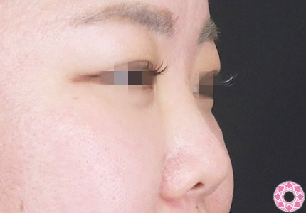 年代：30代 施術名：プチ隆鼻術（ヒアルロン酸） 施術前｜【公式】東京形成美容外科