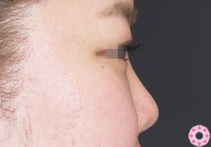 年代：30代 施術名：プチ隆鼻術（ヒアルロン酸） 施術前｜【公式】東京形成美容外科