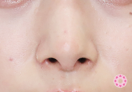 年代：20代 施術名：小鼻縮小 施術後｜【公式】東京形成美容外科
