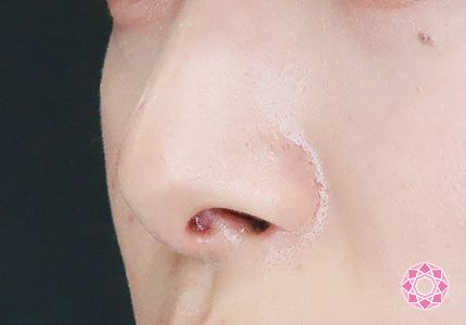 年代：20代 施術名：小鼻縮小 施術後｜【公式】東京形成美容外科