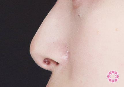 年代：20代 施術名：小鼻縮小 施術後｜【公式】東京形成美容外科