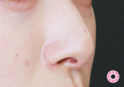 年代：20代 施術名：小鼻縮小 施術後｜【公式】東京形成美容外科