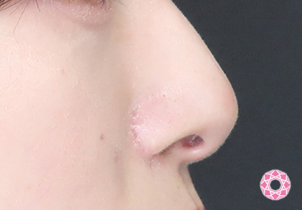 年代：20代 施術名：小鼻縮小 施術後｜【公式】東京形成美容外科