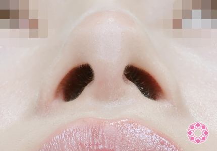 年代：20代 施術名：小鼻縮小 施術後｜【公式】東京形成美容外科