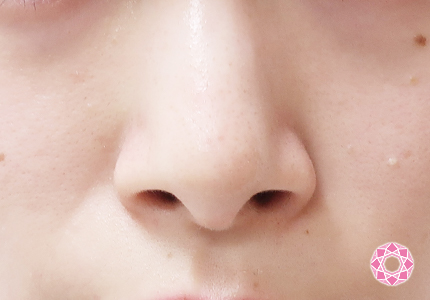 年代：20代 施術名：小鼻縮小 施術前｜【公式】東京形成美容外科