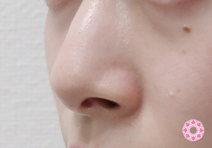 年代：20代 施術名：小鼻縮小 施術前｜【公式】東京形成美容外科