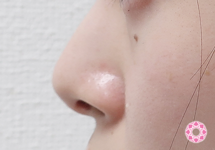 年代：20代 施術名：小鼻縮小 施術前｜【公式】東京形成美容外科