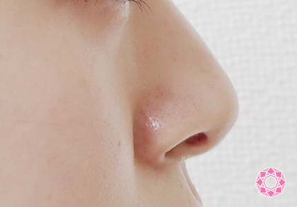 年代：20代 施術名：小鼻縮小 施術前｜【公式】東京形成美容外科