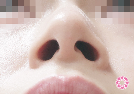 年代：20代 施術名：小鼻縮小 施術前｜【公式】東京形成美容外科