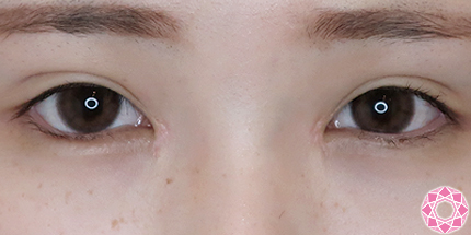 年代：20代 施術名：たれ目形成 施術後｜【公式】東京形成美容外科