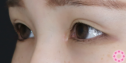 年代：20代 施術名：たれ目形成 施術後｜【公式】東京形成美容外科